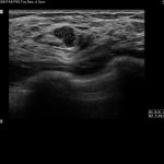 Ultrasound Breast Image
