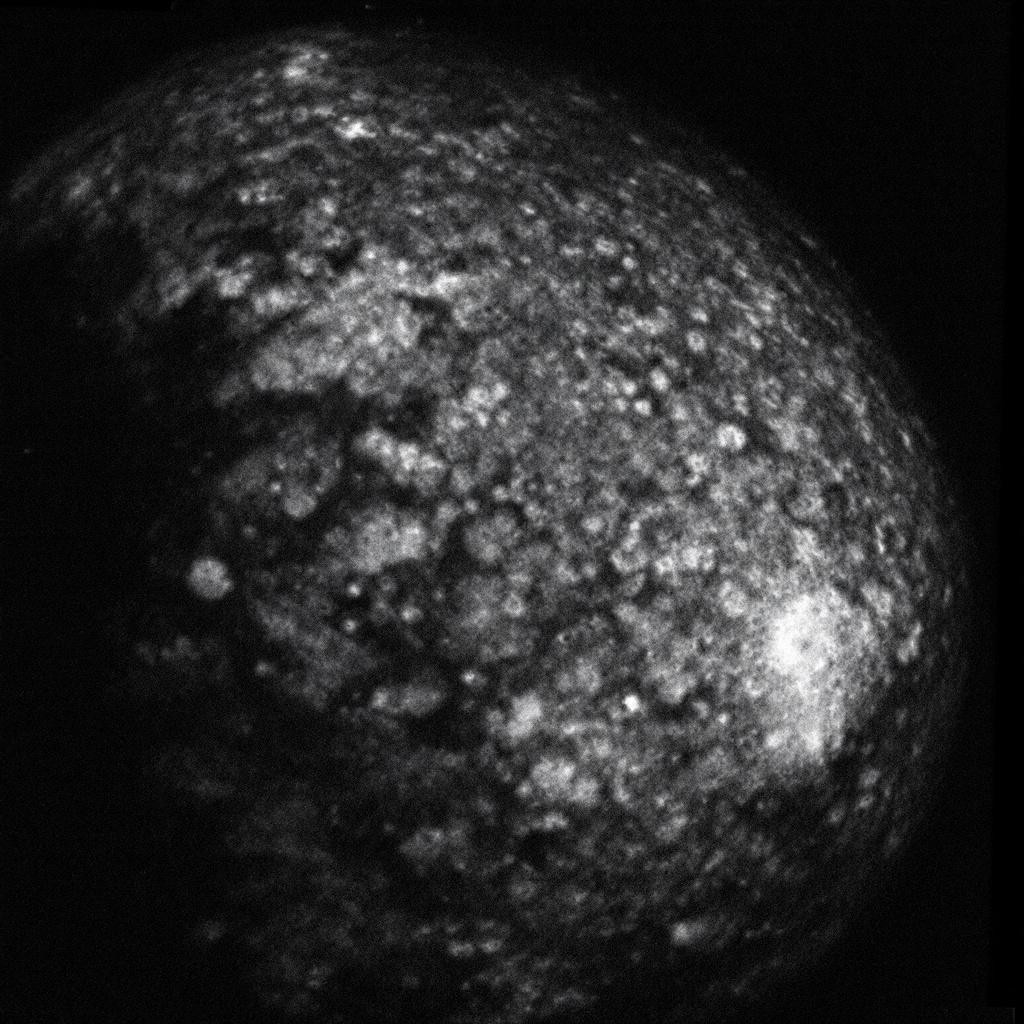 Mammogram Oral Cases In Frcr 2b