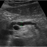 18 Pancreas