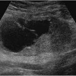 25 Complex 6cm Ovarian Cyst