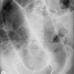 26. Axr Garwood Sigmoid Volvulus