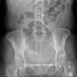 Axr Caecal Volvulus Mohammedlabelled