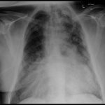 Cxr Left Apex