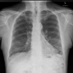 Cxr Lower Lobe Reticular Nodular Change