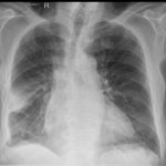 Cxr Right Lung Effusion And Consolidation