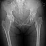 Msk There Is Deformity Of Both Femoral Necks And Also Abnormal Shaped Pubic Bones I Suspect There Is An Underlying Bone Dysplasia, Such As Diaphyseal Aclasia