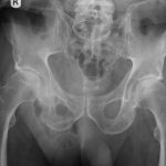 Msk X Ray Pelvis Rt Groin Hernia