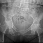 Msk Pelvis Myeloma Wxample 2