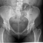 Msk Pelvis With Bilateral Hip Dysplasia And Shallow Acetabula