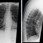 Msk Thoracic Spine Right Perihilar Nodule