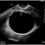 Us Cyst