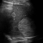 Atypical Liver Lesion