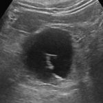 Bosniak 2f Cyst