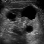 Bosniak 3 Cyst