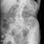Case14porceleingallbladderlsbelled