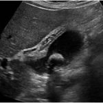Cholecystitis