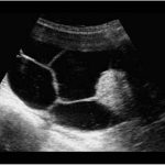 Complex Cyst Young Lady