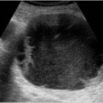 Complex Liver Cyst