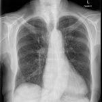 Cxr Dens Rt Hilum