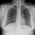 Cxr Left Lung Near 6th Rib And Right Apex Near 1 2 Ribs