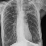 Cxr Left Uppe Rlobe Cavity Right Apical Changes