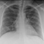 Cxr Multifocal Consolidation