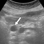 Cyst