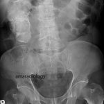 Damaged Kidney Axr Mohammed Labelled