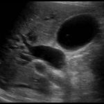 Dilated Bile Duct