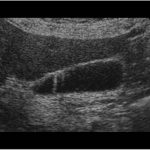 Gb Adenomyaosis