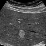 Haemangioma