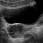Haemorrhagic Cyst