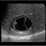 Hydatid Cyst