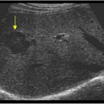 Indeterminate Liver Lesion