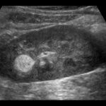 Kidney Aml