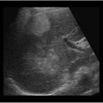 Large Liver Lesions