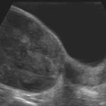 Large Ovarian Mass