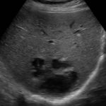 Liver Abscess