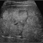 Liver Metastasis