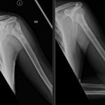 Msk Shoulder Sclerosed Haemangioma