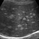 Multiple Liver Lesions