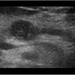 Pancreaic Cancer