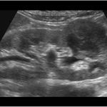 Renal Mass