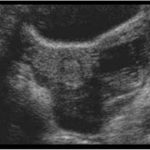 Ruptured Haemorrhagic Cyst Young Lady