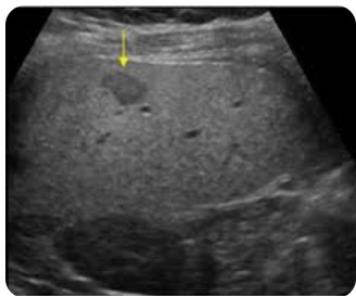 Liver Ultrasound