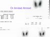 17 Hyperthyroidism