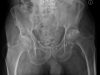 18 Bone Scan 3 Oa Xray