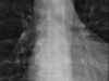 19 Bone Scan With Thoracic Uptake X Ray (1)
