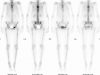 20 Bone Scan 3 Pelvc Lesion And Thoracic Spine Lesion