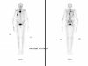 21 Bone Scan Metastatic Cancer